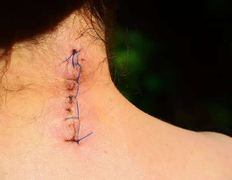 Narbenbehandlung